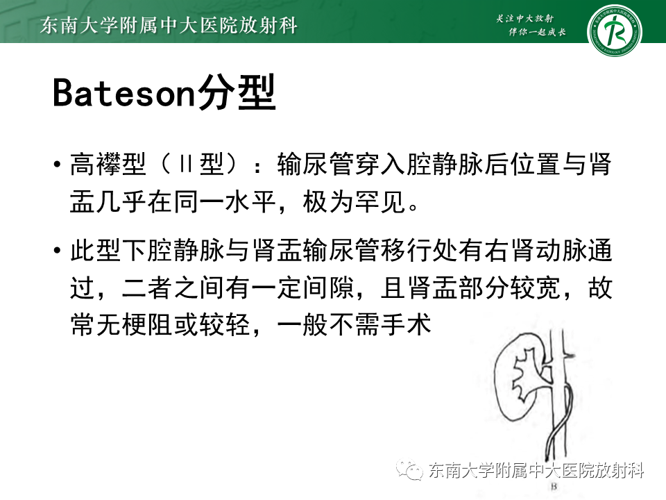 影像PPT - 【PPT】下腔静脉后输尿管及输尿管先天变异-10