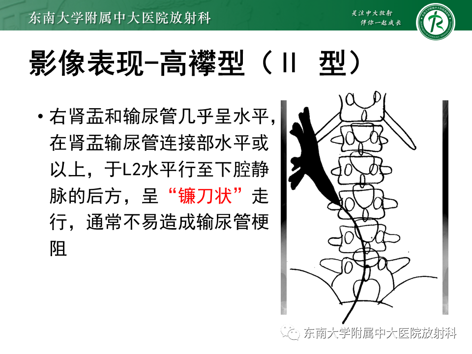 影像PPT - 【PPT】下腔静脉后输尿管及输尿管先天变异-11