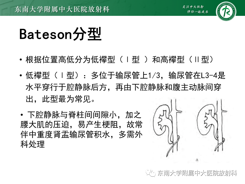 影像PPT - 【PPT】下腔静脉后输尿管及输尿管先天变异-9