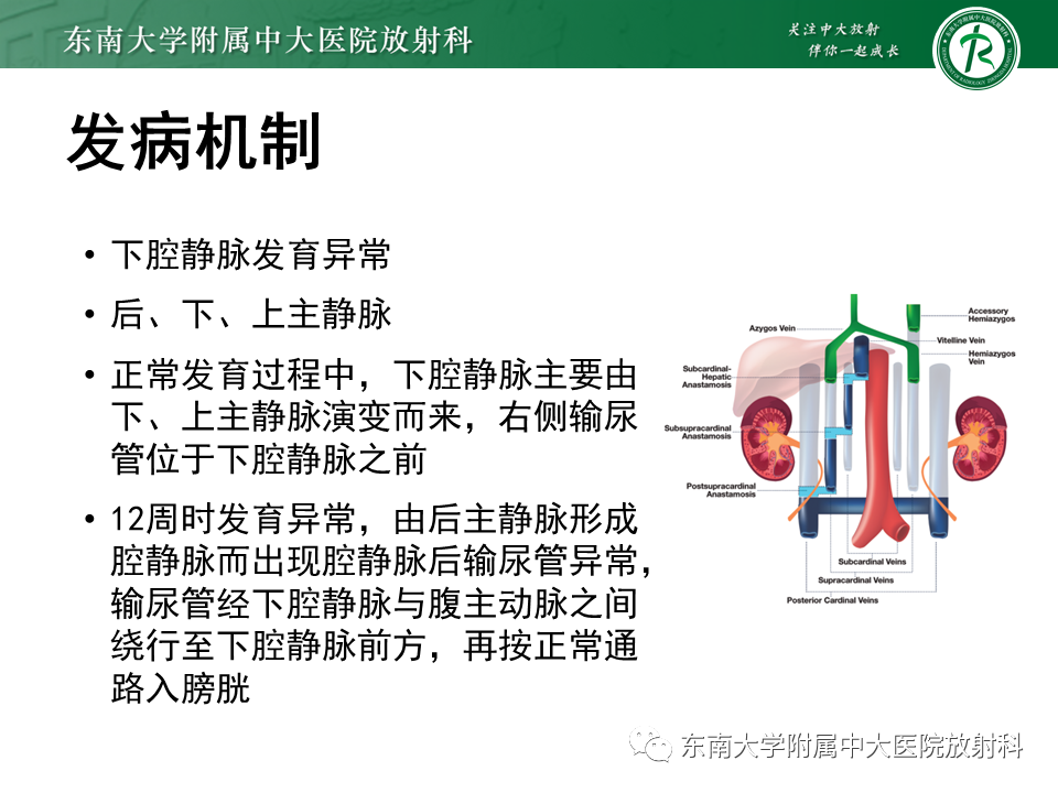 影像PPT - 【PPT】下腔静脉后输尿管及输尿管先天变异-7
