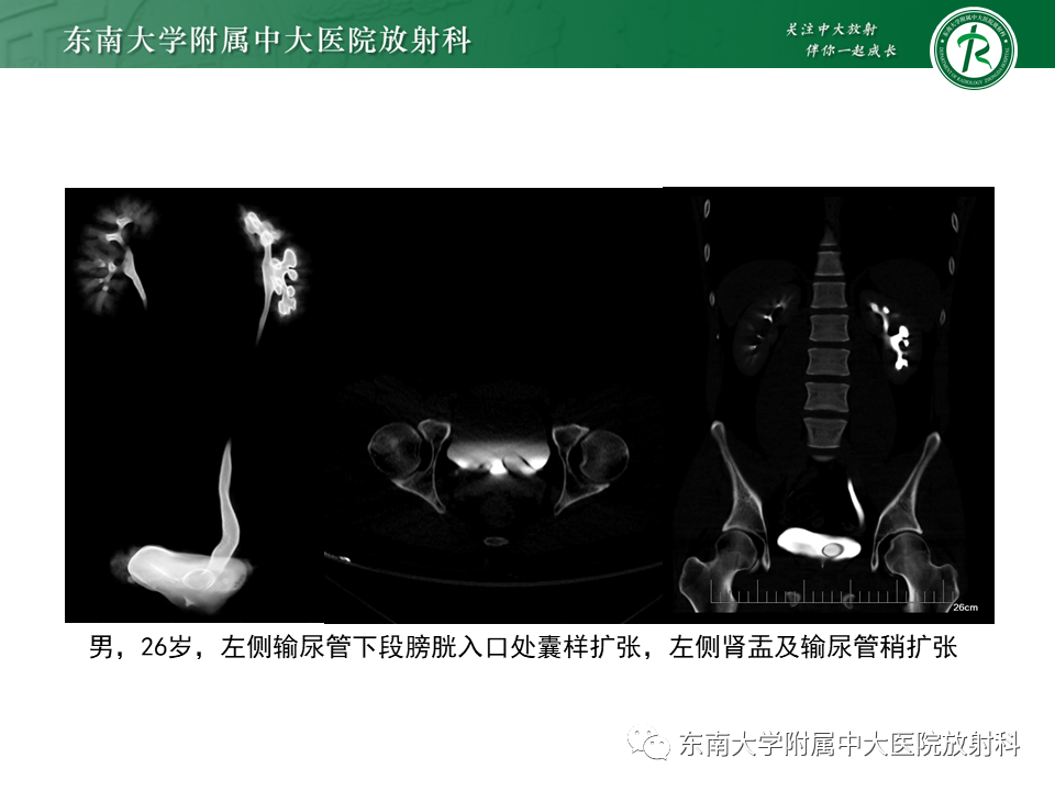 影像PPT - 【PPT】下腔静脉后输尿管及输尿管先天变异-13