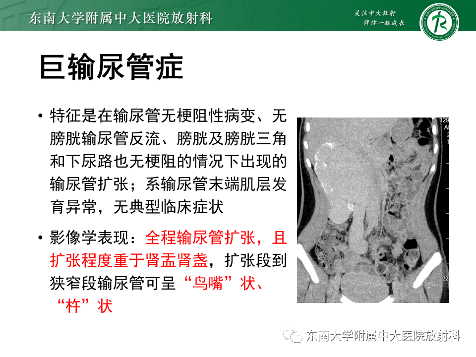 影像PPT - 【PPT】下腔静脉后输尿管及输尿管先天变异-14