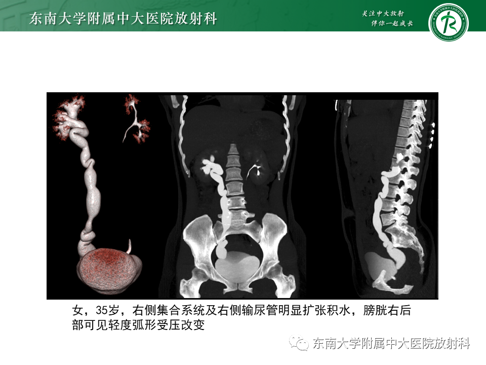影像PPT - 【PPT】下腔静脉后输尿管及输尿管先天变异-15