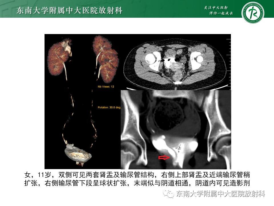 影像PPT - 【PPT】下腔静脉后输尿管及输尿管先天变异-17