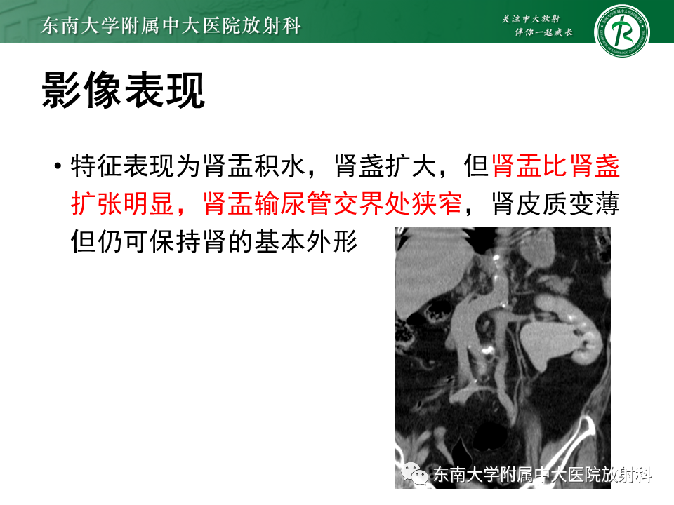 影像PPT - 【PPT】下腔静脉后输尿管及输尿管先天变异-19