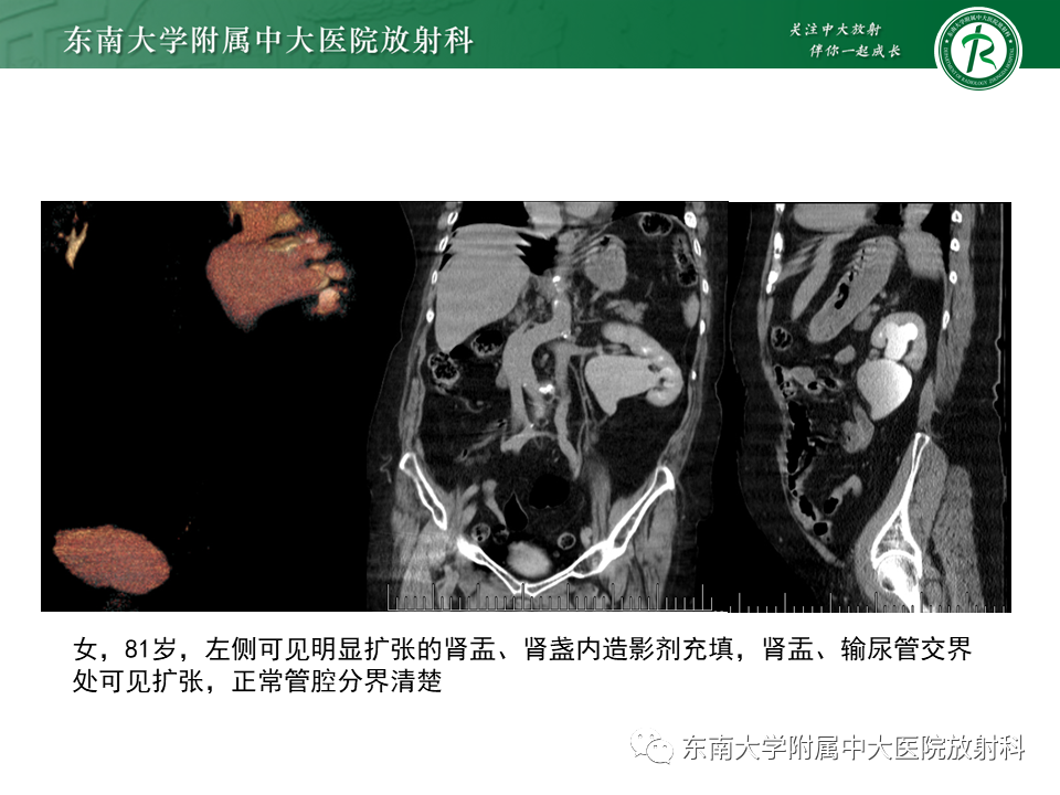影像PPT - 【PPT】下腔静脉后输尿管及输尿管先天变异-20