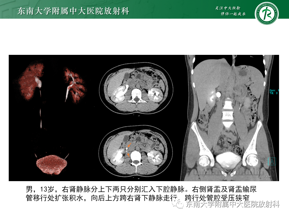 影像PPT - 【PPT】下腔静脉后输尿管及输尿管先天变异-22