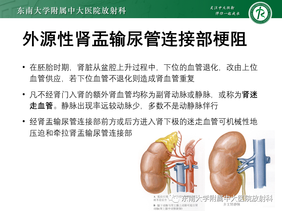 影像PPT - 【PPT】下腔静脉后输尿管及输尿管先天变异-21