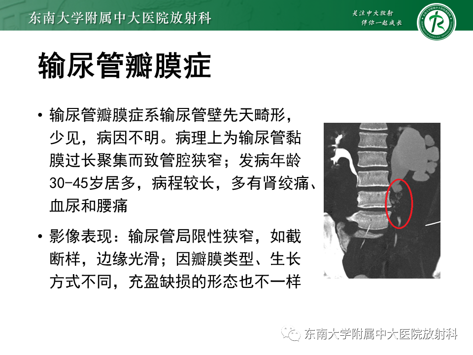 影像PPT - 【PPT】下腔静脉后输尿管及输尿管先天变异-23