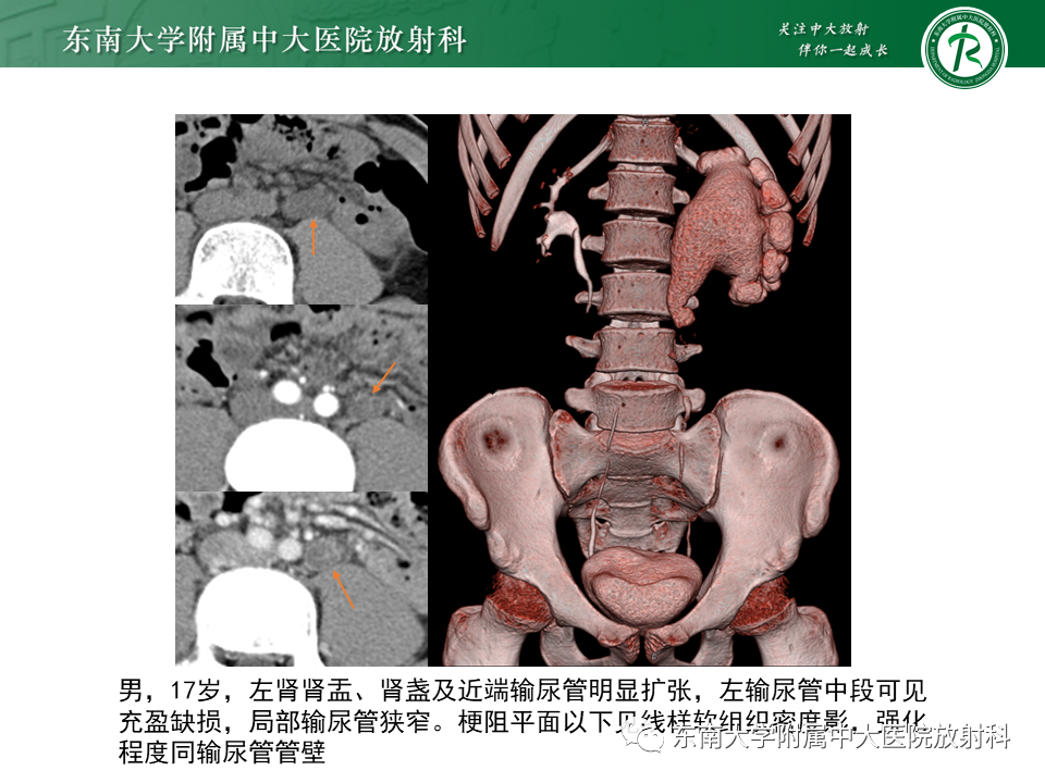 影像PPT - 【PPT】下腔静脉后输尿管及输尿管先天变异-24