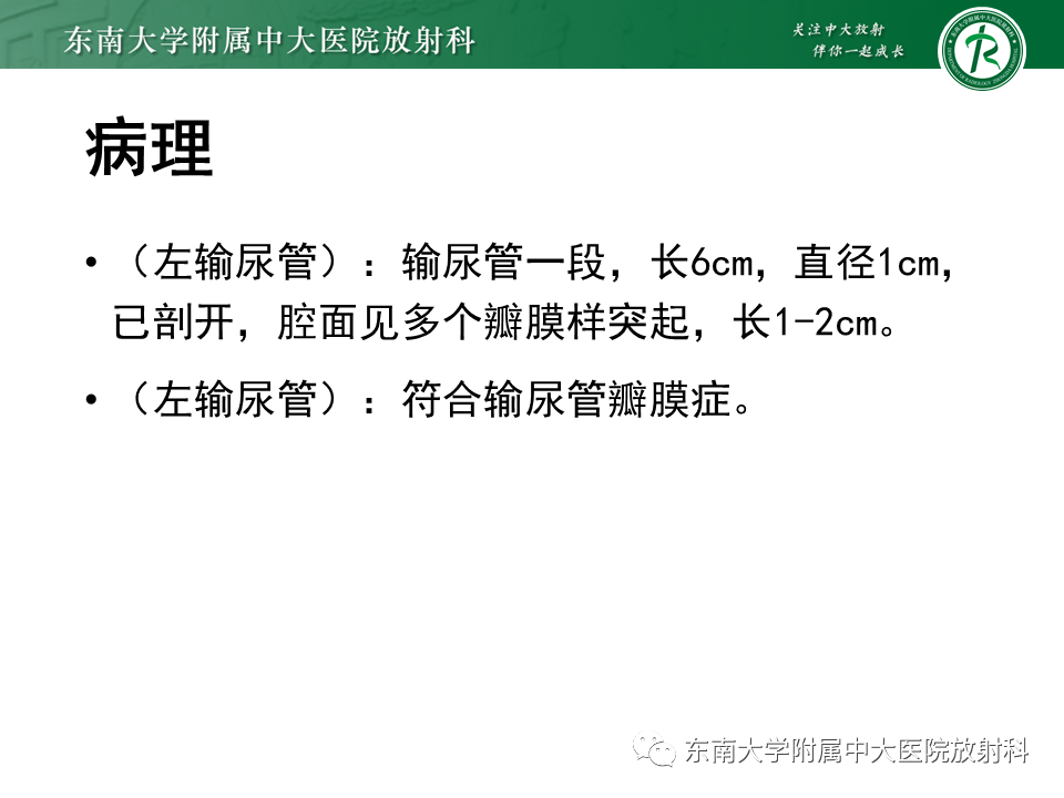 影像PPT - 【PPT】下腔静脉后输尿管及输尿管先天变异-25
