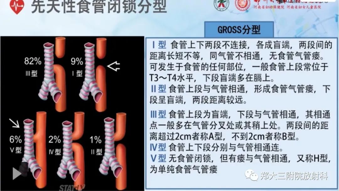 影像PPT - 【PPT】先天性食管闭锁-6