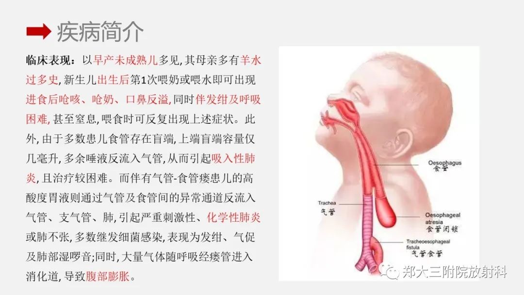 影像PPT - 【PPT】先天性食管闭锁-8