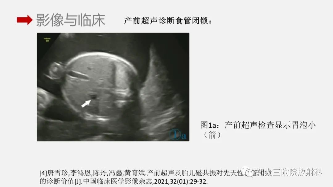 影像PPT - 【PPT】先天性食管闭锁-12