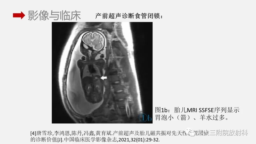 影像PPT - 【PPT】先天性食管闭锁-13