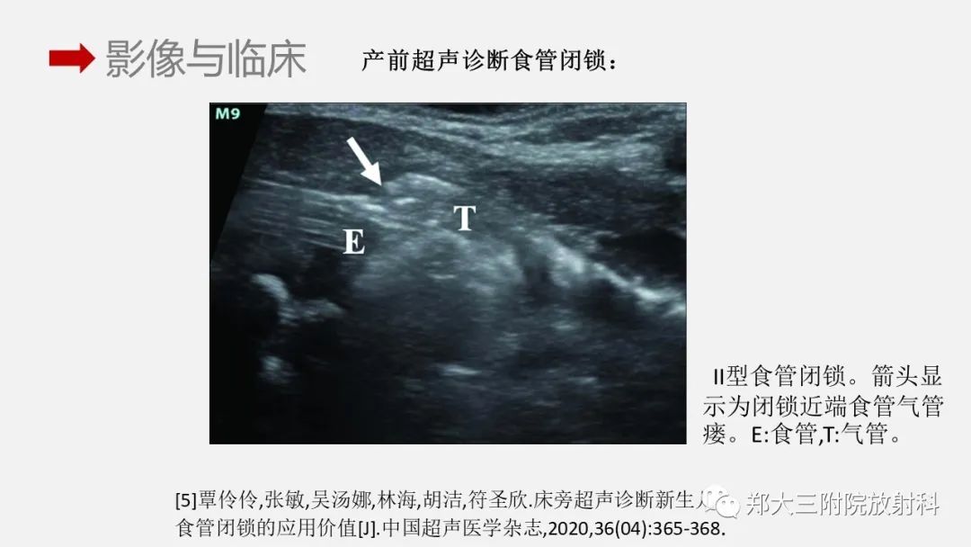 影像PPT - 【PPT】先天性食管闭锁-15