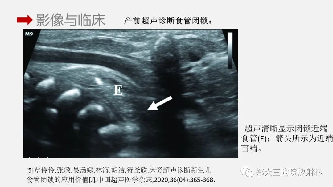 影像PPT - 【PPT】先天性食管闭锁-14