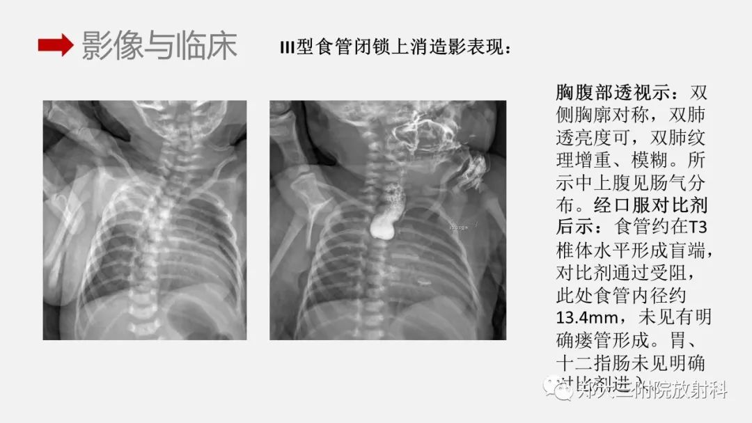 影像PPT - 【PPT】先天性食管闭锁-16