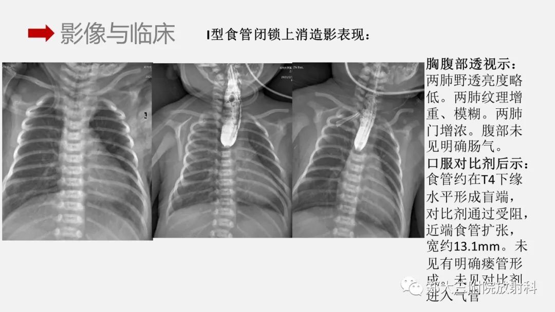 影像PPT - 【PPT】先天性食管闭锁-17