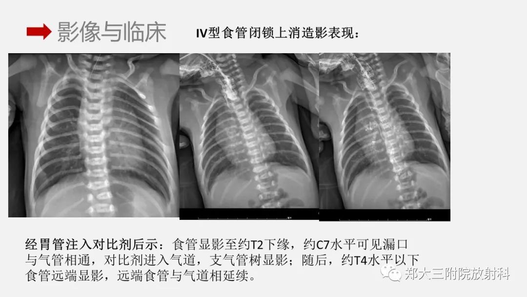 影像PPT - 【PPT】先天性食管闭锁-18