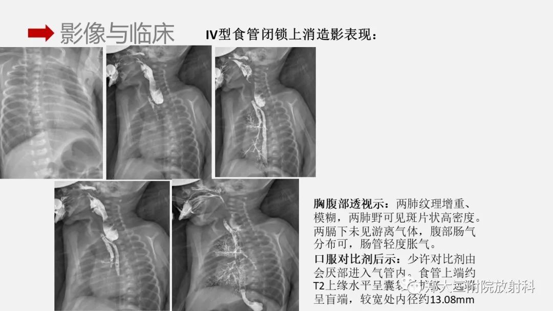 影像PPT - 【PPT】先天性食管闭锁-19