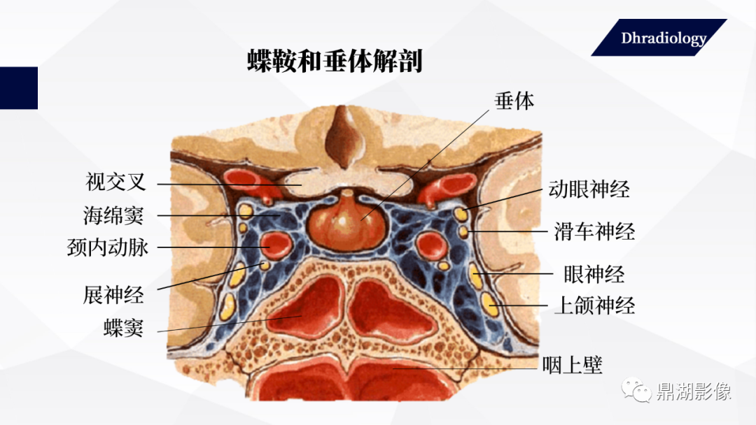 影像PPT - 【PPT】垂体瘤影像诊断-4