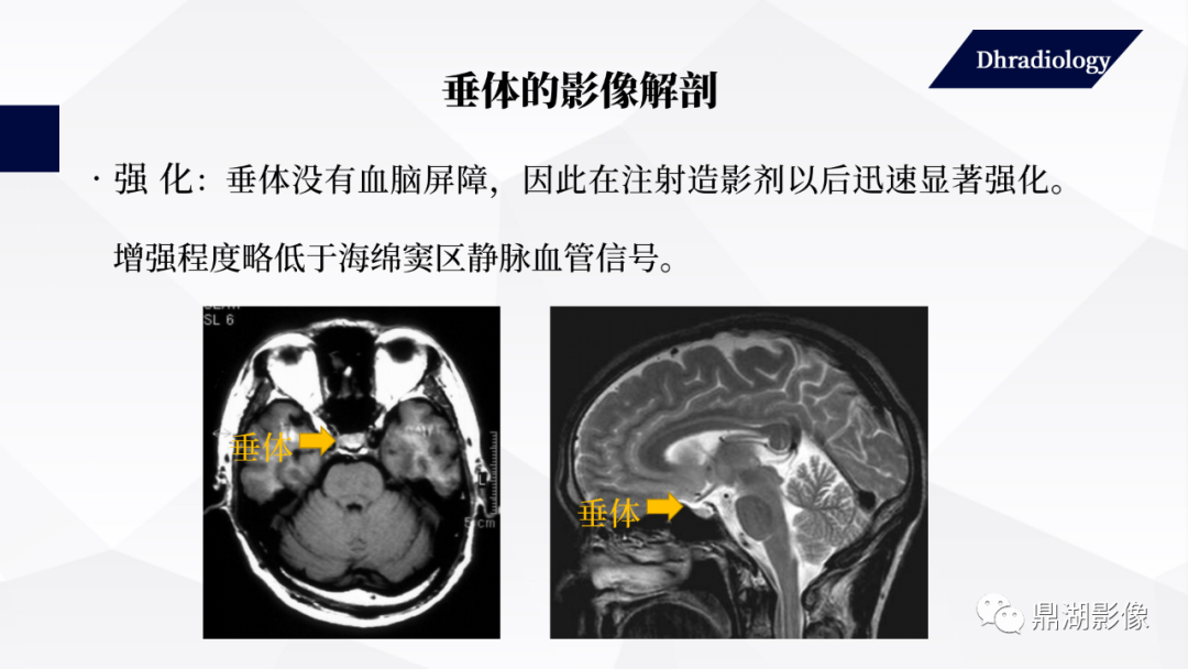 影像PPT - 【PPT】垂体瘤影像诊断-14