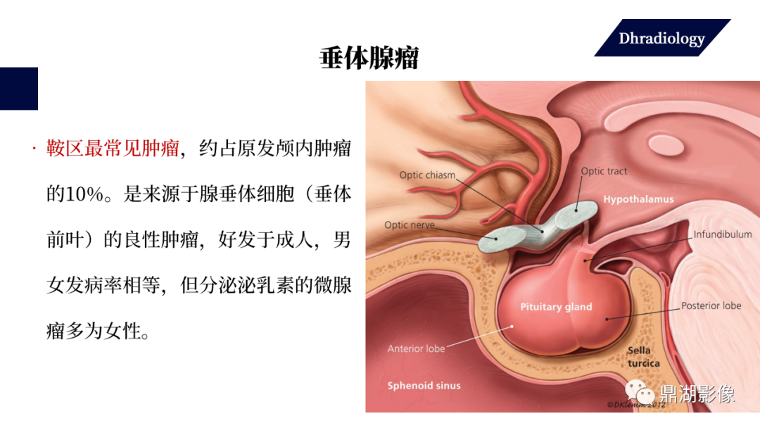 影像PPT - 【PPT】垂体瘤影像诊断-15