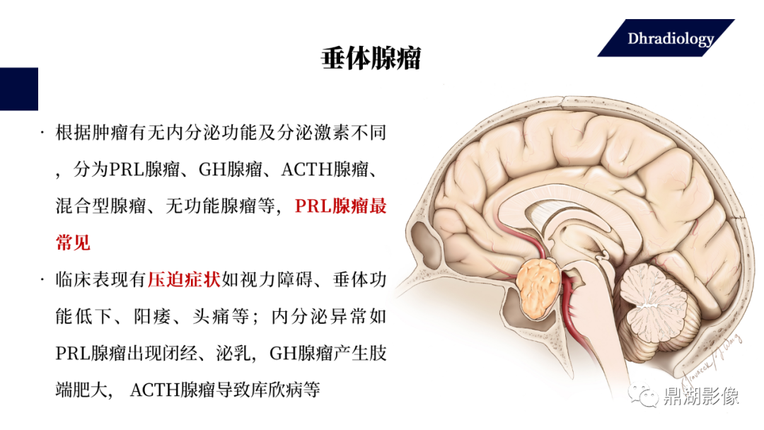影像PPT - 【PPT】垂体瘤影像诊断-16