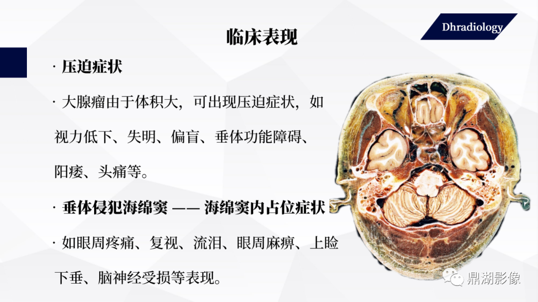 影像PPT - 【PPT】垂体瘤影像诊断-22