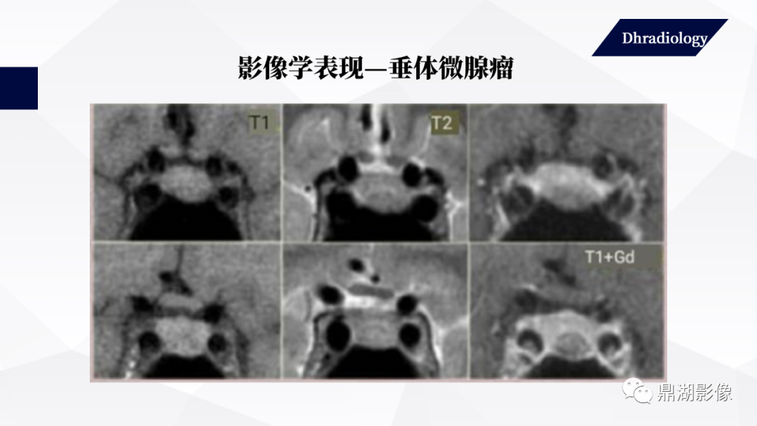 影像PPT - 【PPT】垂体瘤影像诊断-32
