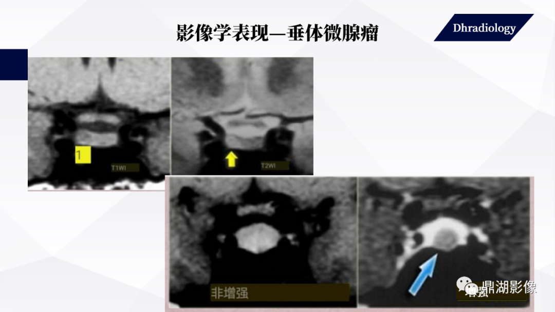 影像PPT - 【PPT】垂体瘤影像诊断-31
