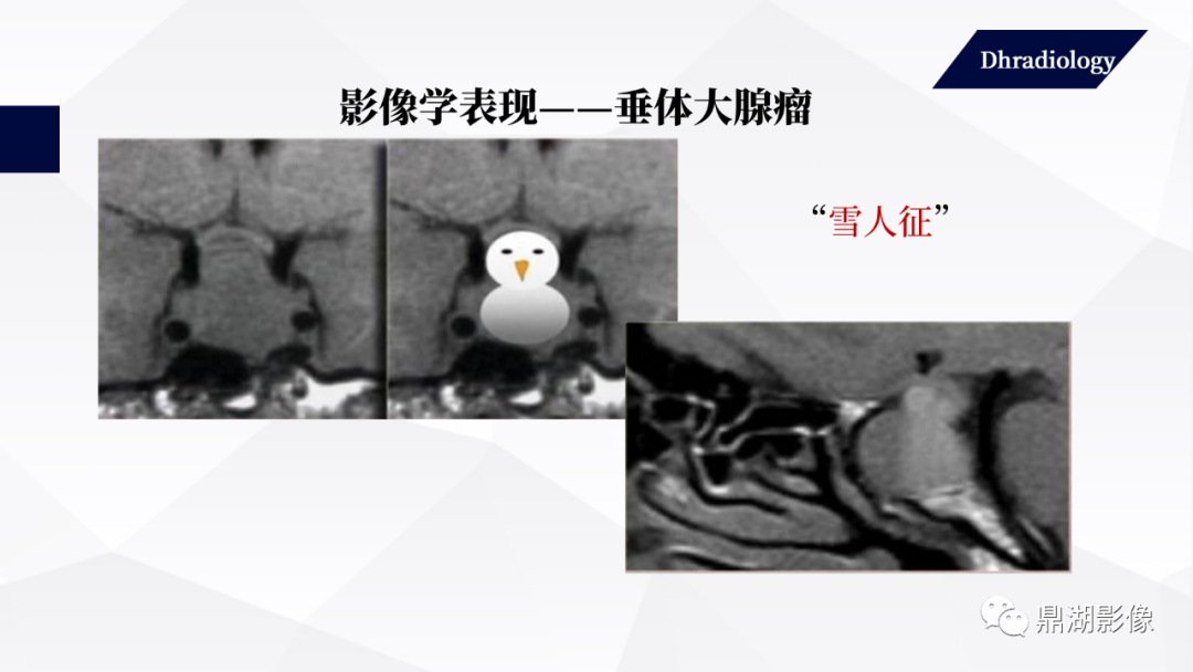 影像PPT - 【PPT】垂体瘤影像诊断-34