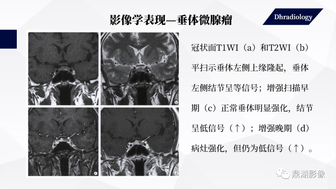 影像PPT - 【PPT】垂体瘤影像诊断-30