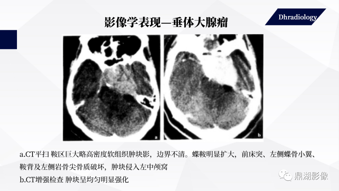 影像PPT - 【PPT】垂体瘤影像诊断-38