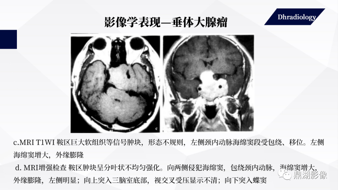 影像PPT - 【PPT】垂体瘤影像诊断-39