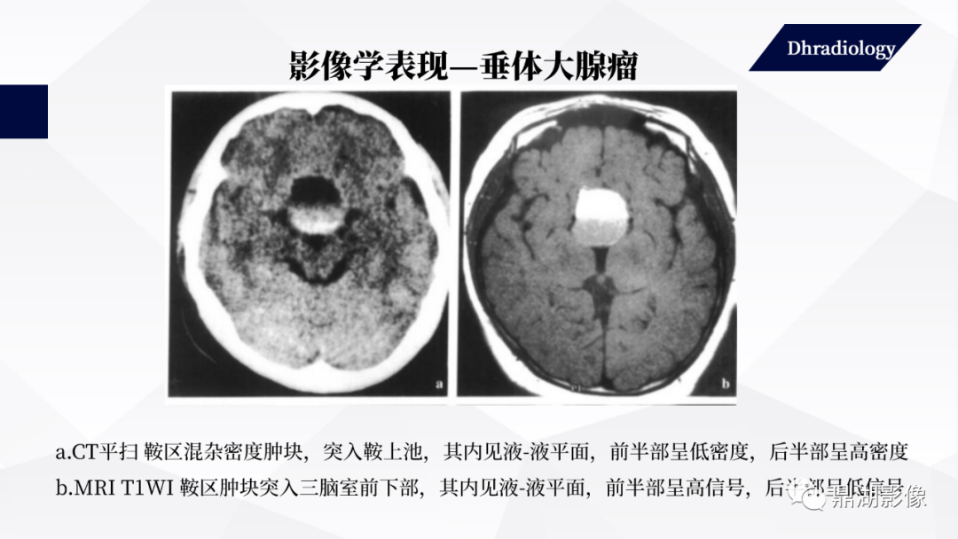 影像PPT - 【PPT】垂体瘤影像诊断-42