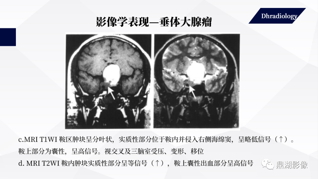 影像PPT - 【PPT】垂体瘤影像诊断-43