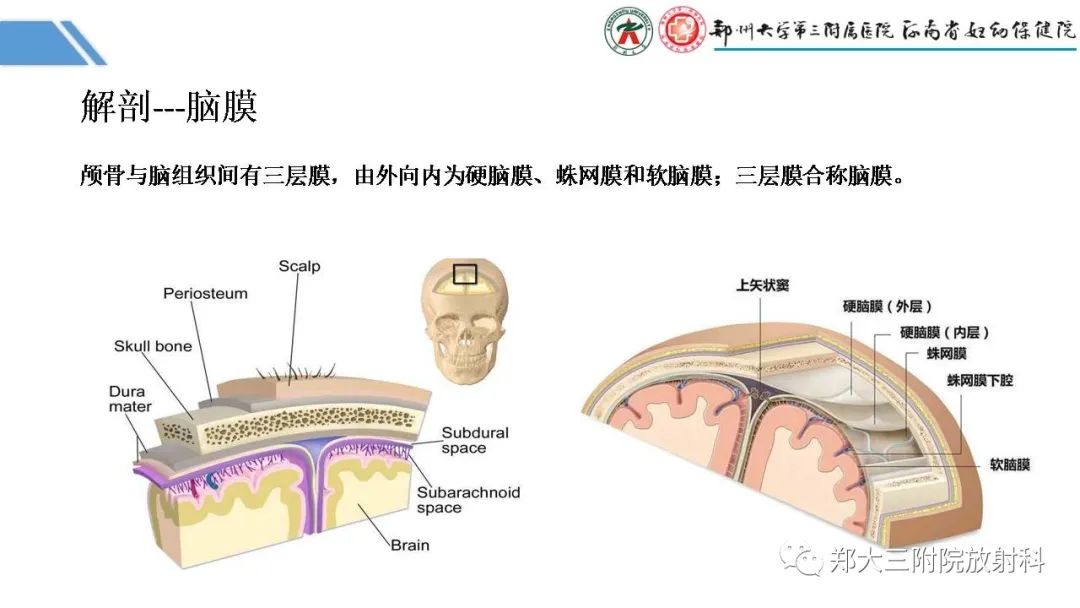 影像PPT - 【PPT】蛛网膜颗粒的影像学表现-2