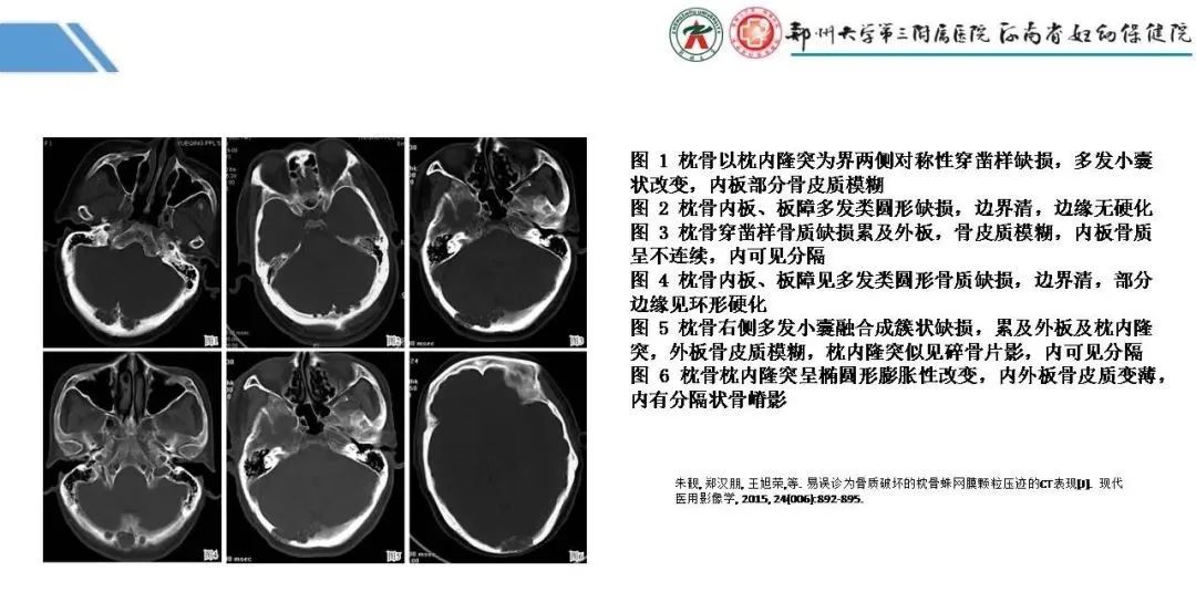 影像PPT - 【PPT】蛛网膜颗粒的影像学表现-9