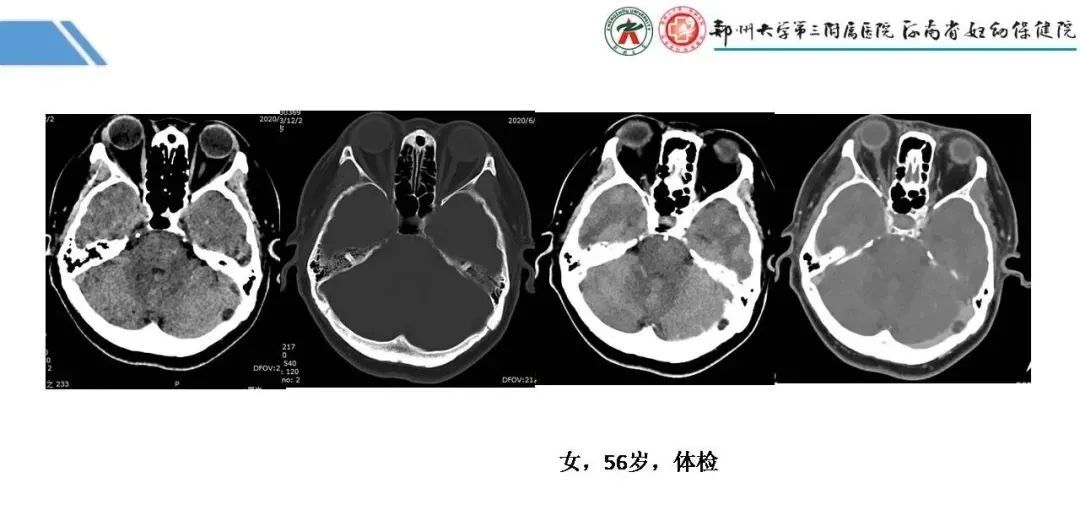 影像PPT - 【PPT】蛛网膜颗粒的影像学表现-10