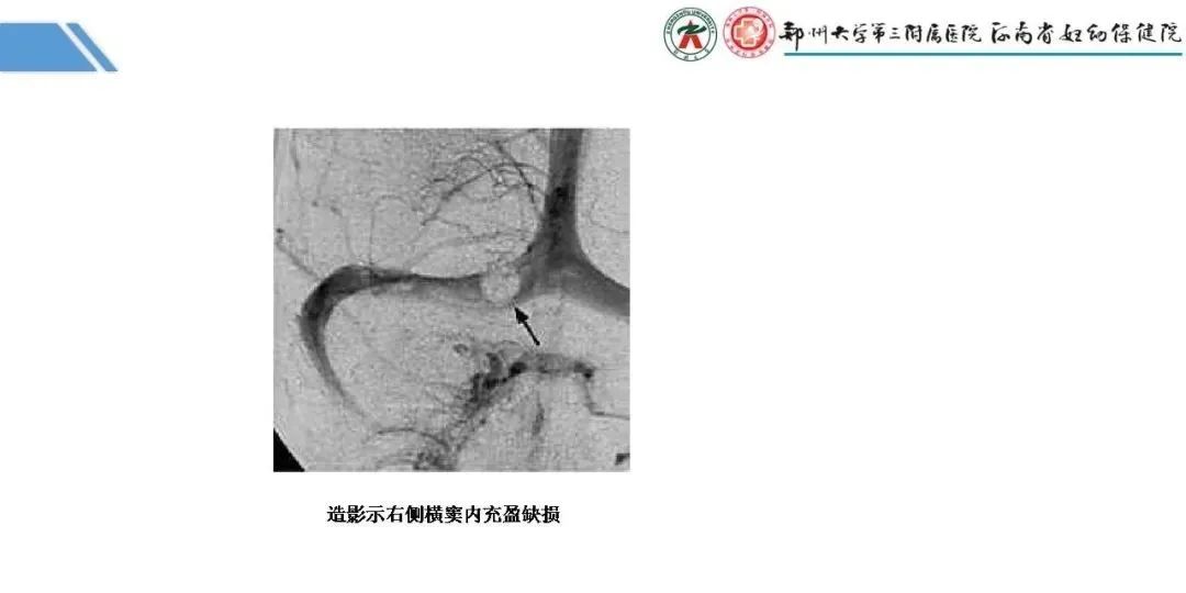 影像PPT - 【PPT】蛛网膜颗粒的影像学表现-11