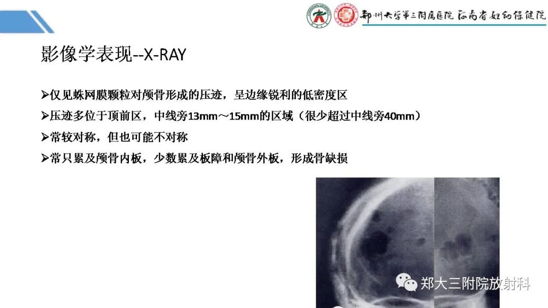 影像PPT - 【PPT】蛛网膜颗粒的影像学表现-7