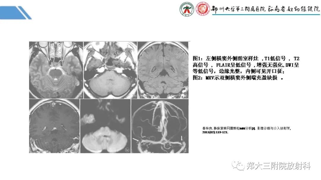 影像PPT - 【PPT】蛛网膜颗粒的影像学表现-13