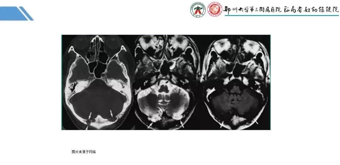 影像PPT - 【PPT】蛛网膜颗粒的影像学表现-14