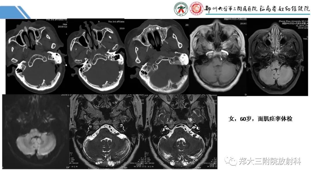 影像PPT - 【PPT】蛛网膜颗粒的影像学表现-16