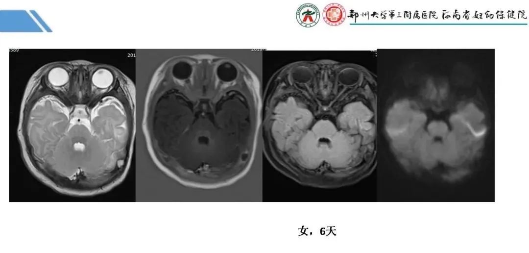 影像PPT - 【PPT】蛛网膜颗粒的影像学表现-15