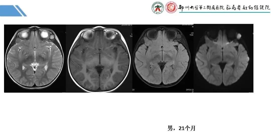 影像PPT - 【PPT】蛛网膜颗粒的影像学表现-22
