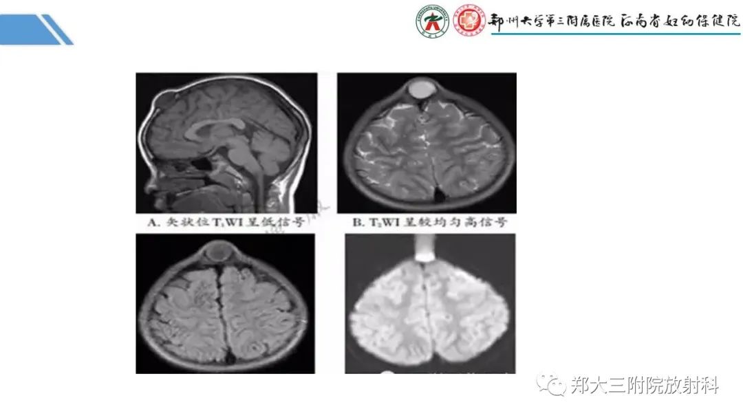影像PPT - 【PPT】蛛网膜颗粒的影像学表现-21
