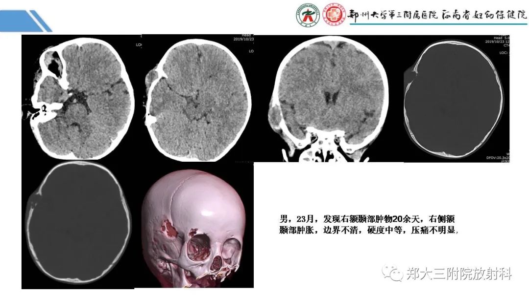影像PPT - 【PPT】蛛网膜颗粒的影像学表现-24